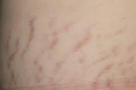Strectch Marks